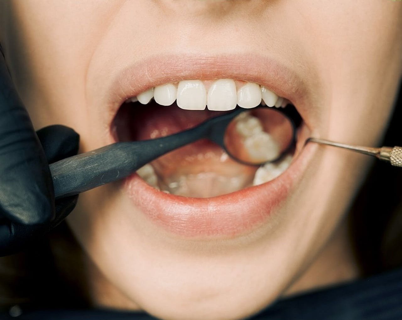 How Long Until a Tooth Infection Kills You Understanding the Risks and Timelines