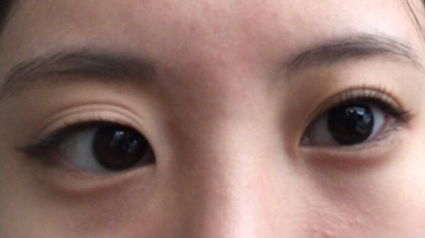 Triple Eyelid Care Essential Tips for Optimal Eye Health and Maintenance